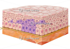 Karzinogenese, Tumorwachstum oder Tumorentwicklung, Schleimhautepithel mit Dysplasie Grad 2 - Medical Pictures