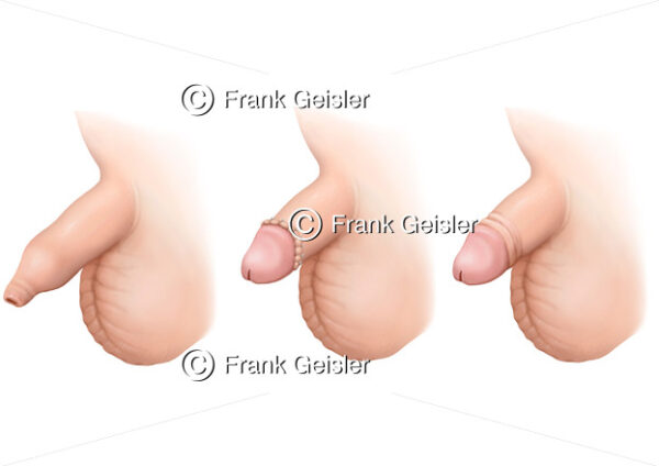 Kinderchirurgie, Phimose  (Vorhautverengung) und Zirkumzision (Beschneidung) - Medical Pictures