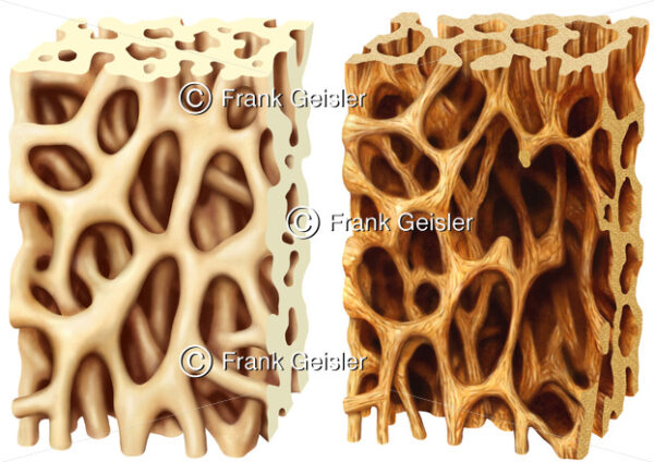 Knochenbälkchen im Knochen, Knochenbau bei Osteoporose (Knochenschwund) - Medical Pictures