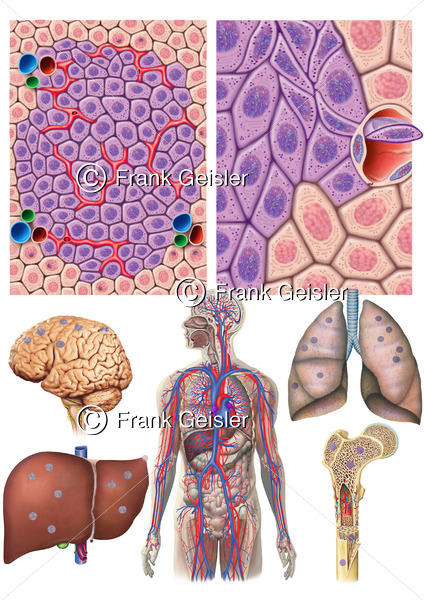 Krebswachstum, Metastasierung Nierenkrebs durch Blutkreislauf, Bildung von Metastasen in Gehirn, Leber, Lunge und Knochen - Medical Pictures