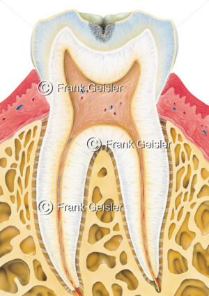 Längsschnitt durch Zahn mit Karies im Zahnschmelz (Schmelzkaries) - Medical Pictures