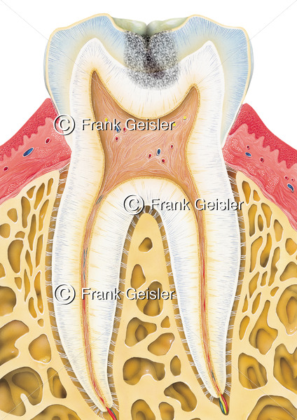 Längsschnitt durch Zahn mit Karies media im Zahnschmelz (Schmelzkaries) - Medical Pictures