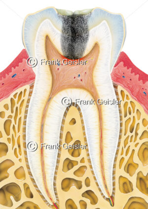 Längsschnitt durch Zahn mit Karies profunda im Zahnschmelz (Schmelzkaries) - Medical Pictures