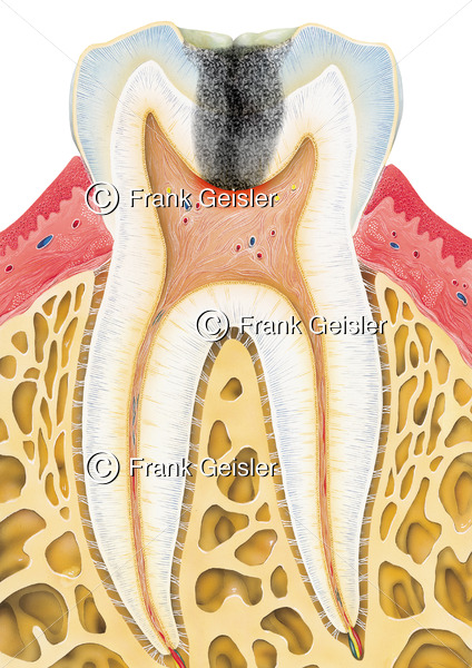 Längsschnitt durch Zahn mit Karies profunda im Zahnschmelz (Schmelzkaries) - Medical Pictures