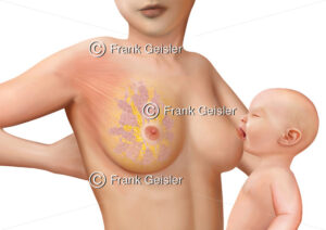 Laktation Brustdrüse mit Drüsenläppchen, Säugling wird mit Muttermilch gestillt - Medical Pictures