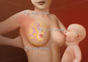 Laktation Brustdrüse mit Drüsenläppchen, Säugling wird mit Muttermilch gestillt - Medical Pictures