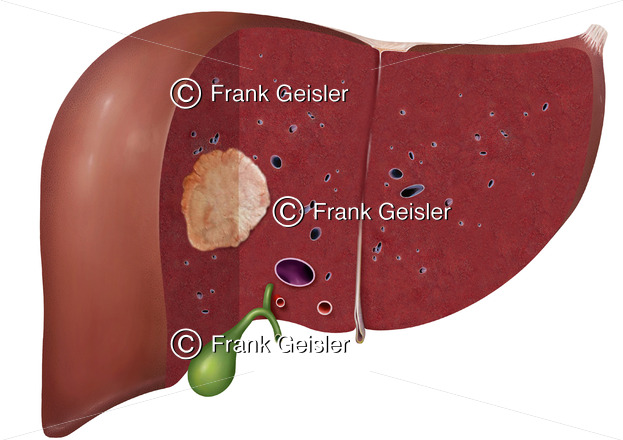 Leber mit Leberkrebs bösartige Geschwulst Leberzellkrebs hepatozelluläres Karzinom Medical