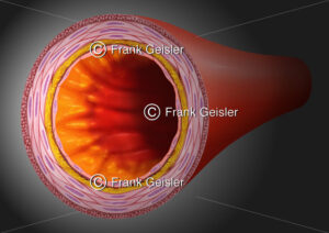 Lumen einer Arterie mit arteriosklerotischen Veränderung der Intima (Intimasklerose) - Medical Pictures