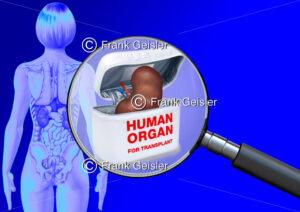 Medical Art Organtransplantation, Organspende Niere der Frau - Medical Pictures