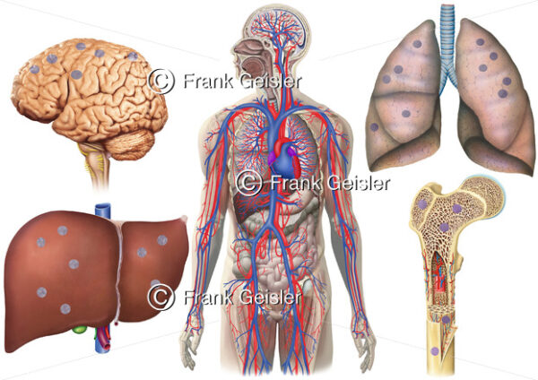 Metastasierung Nierenkrebs durch Blutkreislauf, Bildung von Metastasen in Gehirn, Leber, Lunge und Knochen - Medical Pictures