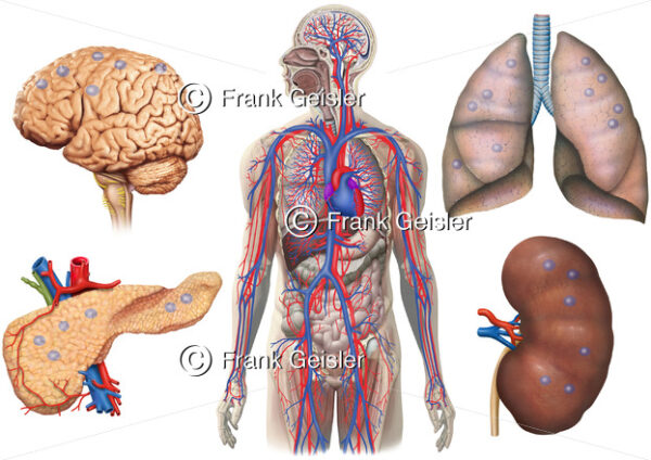 Metastasierung durch Blutkreislauf, Bildung von Metastasen in Gehirn, Lunge, Pankreas und Niere - Medical Pictures
