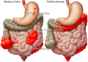 Morbus Crohn und Colitis ulcerosa im Magen-Darm-Bereich - Medical Pictures