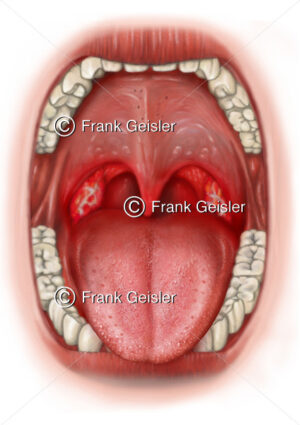 Mund und Rachen mit Mandelentzündung, Angina tonsillaris der Mandeln - Medical Pictures