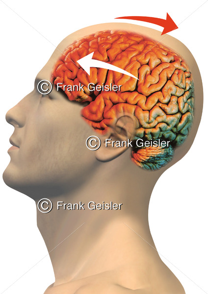 Notfallmedizin, Gehirnerschütterung (Commotio cerebri), Kopf mit Schädel-Hirn-Trauma - Medical Pictures