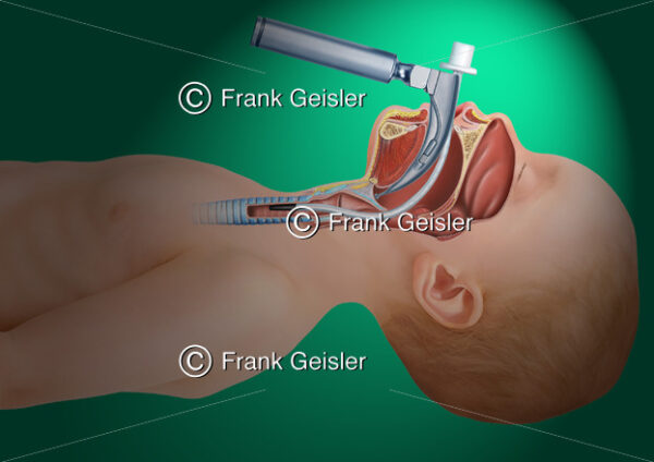 Notfallmedizin, Intubationslaryngoskop und Endotrachealtubus beim Kind - Medical Pictures