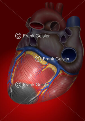 Notfallmedizin, Myokardinfarkt (Herzinfarkt, Herzmuskelinfarkt) des Herzens - Medical Pictures