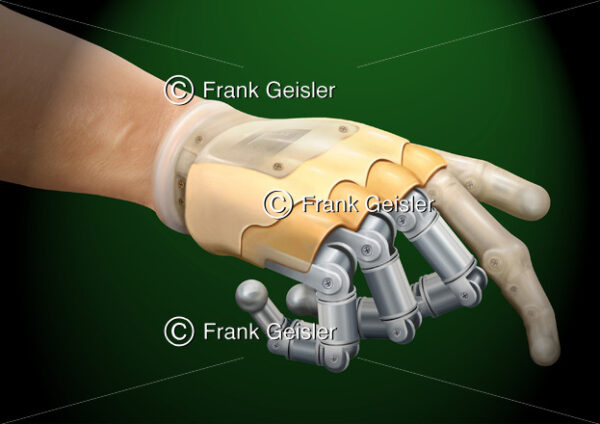 Prothetik, Bionik Handprothese nach Amputation der Hand - Medical Pictures