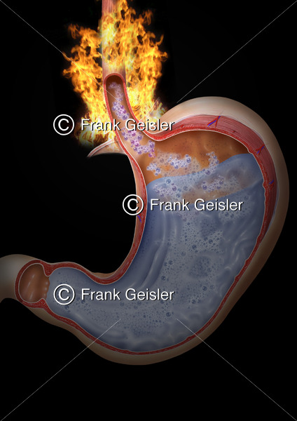Reflux Magen (Ventriculus, Gaster), Sodbrennen in Speiseröhre (Oesophagus) - Medical Pictures
