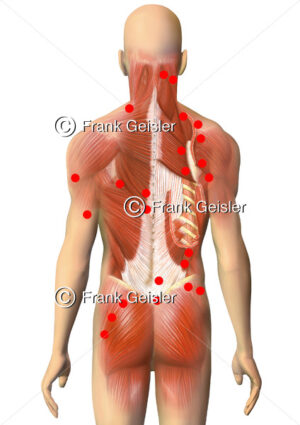 Rückenmuskulatur mit Triggerpunkte für Triggerpunkttherapie gegen Schmerzen der Skelettmuskulatur - Medical Pictures