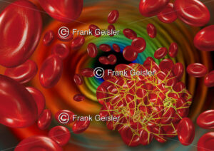 Thrombus im Blutgefäß, Bildung Blutgerinnsel durch intravasale Gerinnung im Blutkreislauf - Medical Pictures