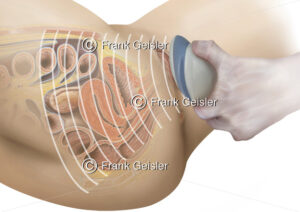 Ultraschalluntersuchung weibliches Becken, Sonografie Beckenorgane der Frau - Medical Pictures