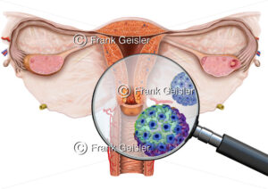 Uterus mit Gebärmutterhalskrebs, Zervixkarzinom Carcinoma cervicis uteri durch Humane Papillomaviren - Medical Pictures