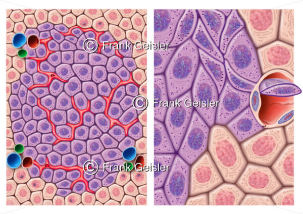 Wachstum hepatozelluläres Karzinom HCC durch Angiogenese und Metastasierung - Medical Pictures