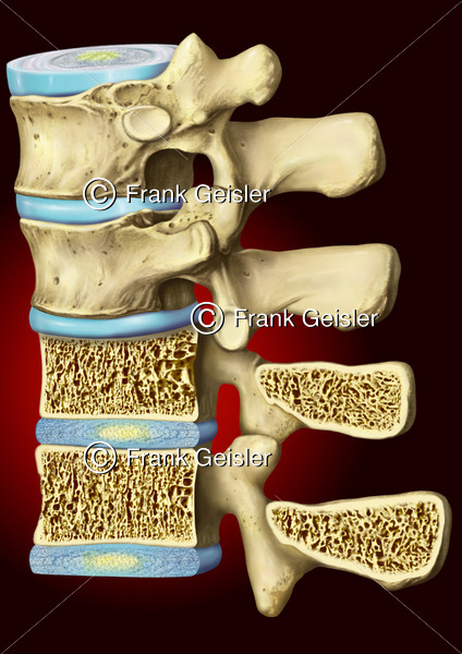 Wirbel der Wirbelsäule mit Osteoporose, Knochenschwund der Wirbelknochen - Medical Pictures
