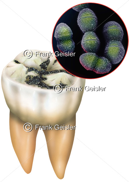 Zahn (Dens) mit Karies durch Streptokokken (Streptococcus) - Medical Pictures
