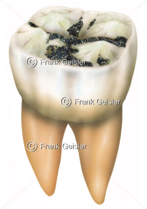 Zahn (Dens) mit Karies durch Streptokokken im Zahnschmelz - Medical Pictures