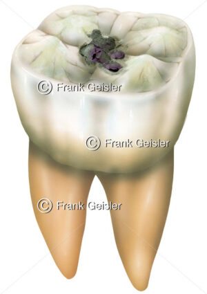 Zahn (Dens) mit Karies im Zahnschmelz (Enamelum) - Medical Pictures