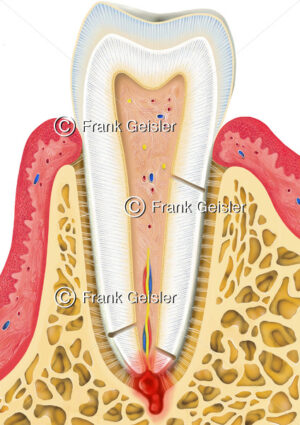 Zahn mit Zahnwurzelzyste, Zahnaufbau mit Kieferzyste an der Zahnwurzel - Medical Pictures