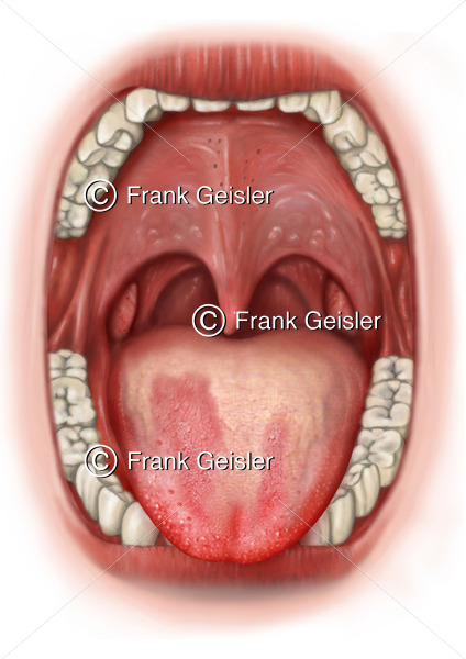 Zungendiagnostik, Zungendiagnose Landkartenzunge und rote Spitze der Zunge bei Gastritis - Medical Pictures