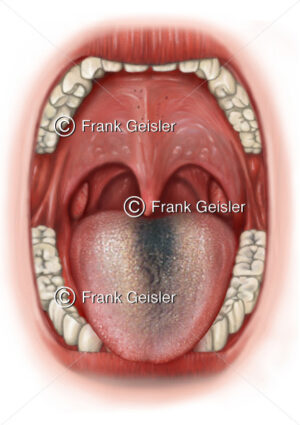 Zungendiagnostik, Zungendiagnose Zungenbelag schwarze Haarzunge Nigritis linguae, Lingua villosa nigra - Medical Pictures