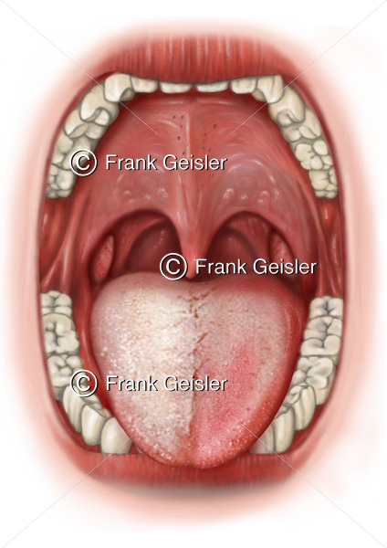 Zungendiagnostik, Zungendiagnose seitlicher Zungenbelag Organe der Organzonen - Medical Pictures