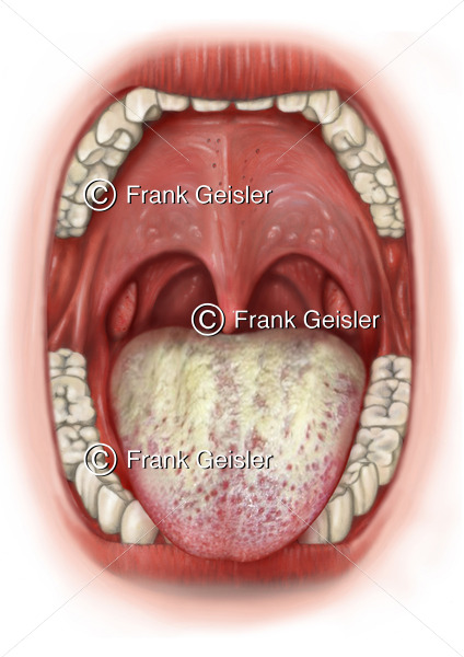Zungendiagnostik, Zungendiagnose weiß gelber Zungenbelag bei Pilzinfektion wie Candida - Medical Pictures